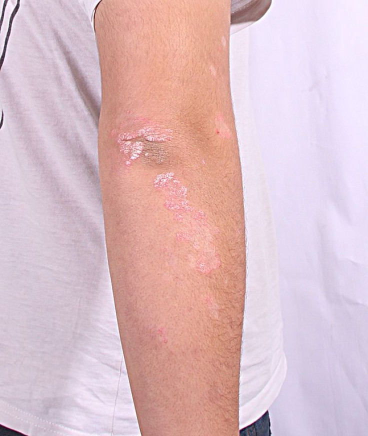 Psoriasis