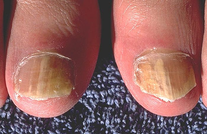 Clone of Clone of Otinea unguium - Nails Ringworm