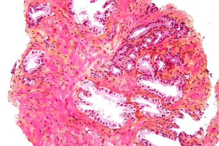 Clone of Prostate adenocarcinoma