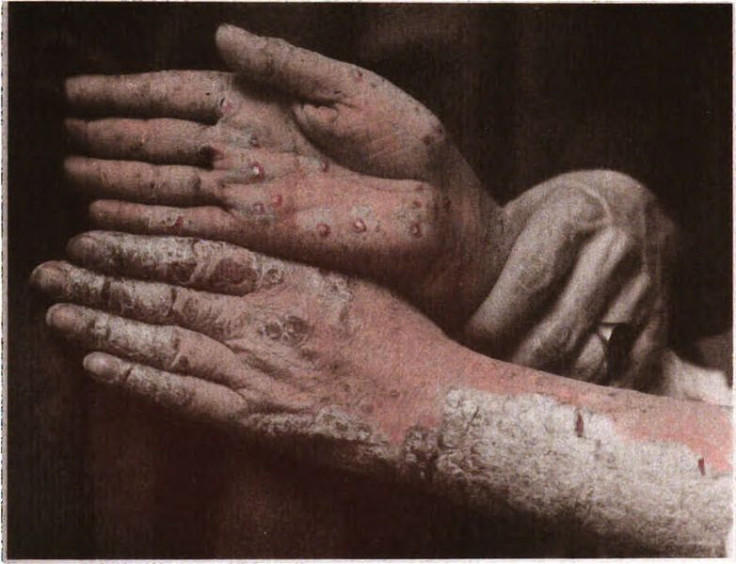 Psoriasis on hands