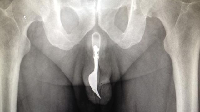Clone of Australian man with fork in penis