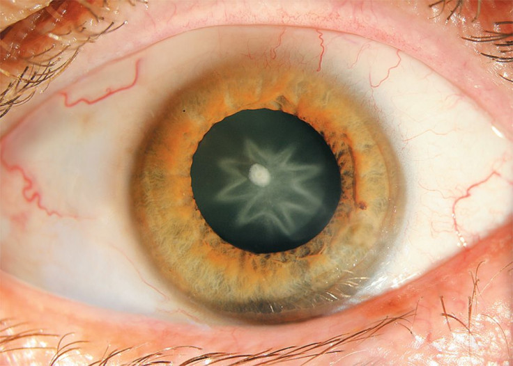 star-cataract-NEJM-130403