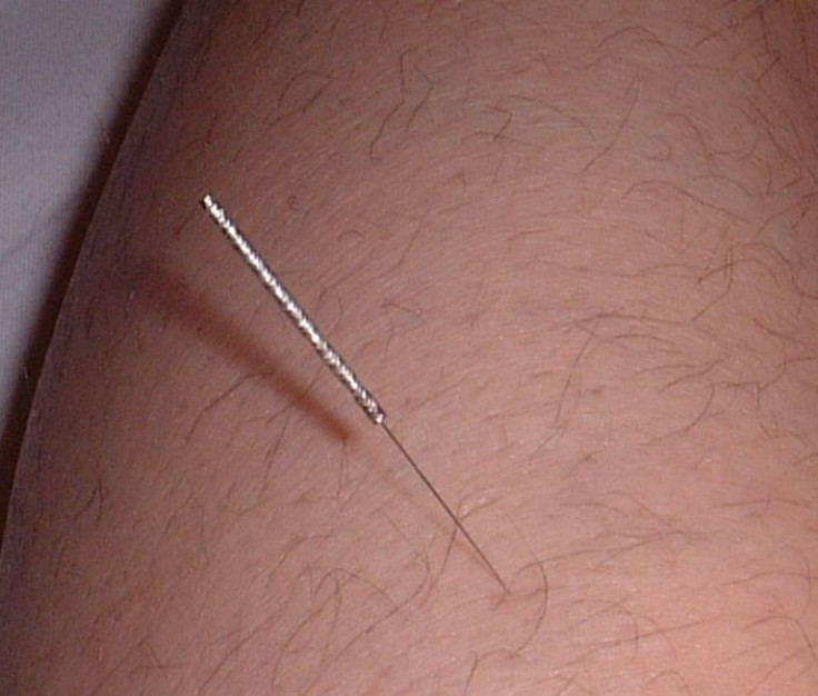 Acupuncture