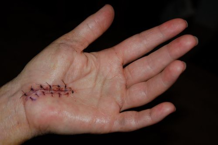 carpal