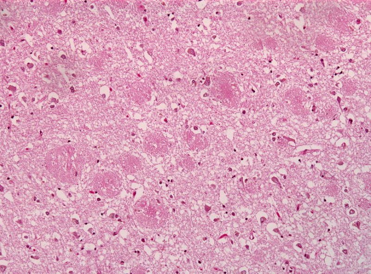 Plaque formation in Alzheimer's disease