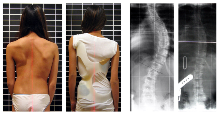 Scoliosis patient in cheneau brace