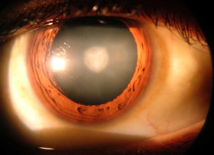 800px-Cataract_in_human_eye