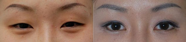 Blepharoplasty, before and after