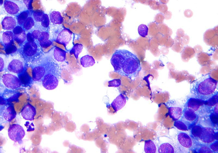 Melanoma cytology field stain