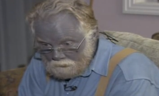 Paul Karanson, 'Papa Smurf' Turned Blue By Colloidal Silver, Dies: Will ...