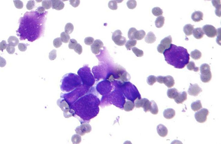 small cell lung cancer cytology