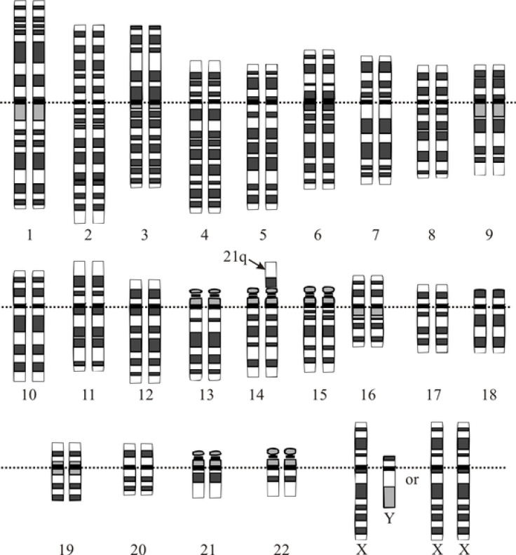 Down syndrome translocation