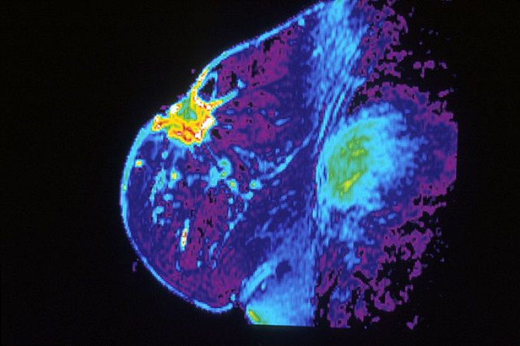 MRI showing breast cancer