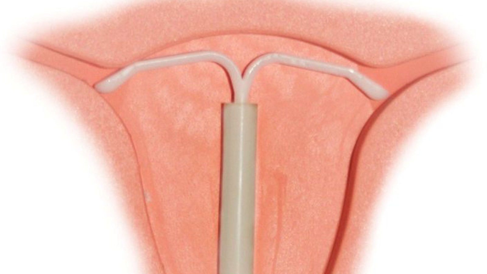 semaglutide and mirena Weight-loss injections such as GLP-1 agonists (including tirzepatide) are increasingly used but they can affect how some oral medications are absorbed, including contraception and Hormone Replacement Therapy (HRT) New Services | Mansfield Miracles, Paul