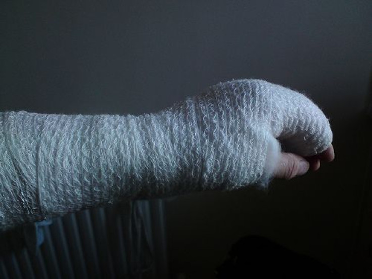 fracture