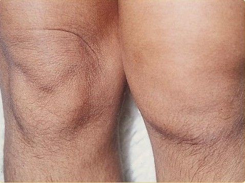 SOA-arthritis