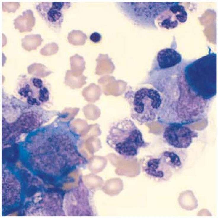 esophageal cancer