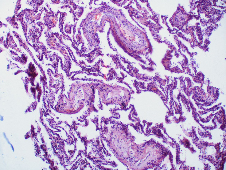 Opsumit Approved By FDA For Pulmonary Arterial Hypertension