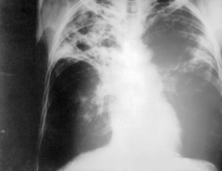 Tuberculosis-x-ray