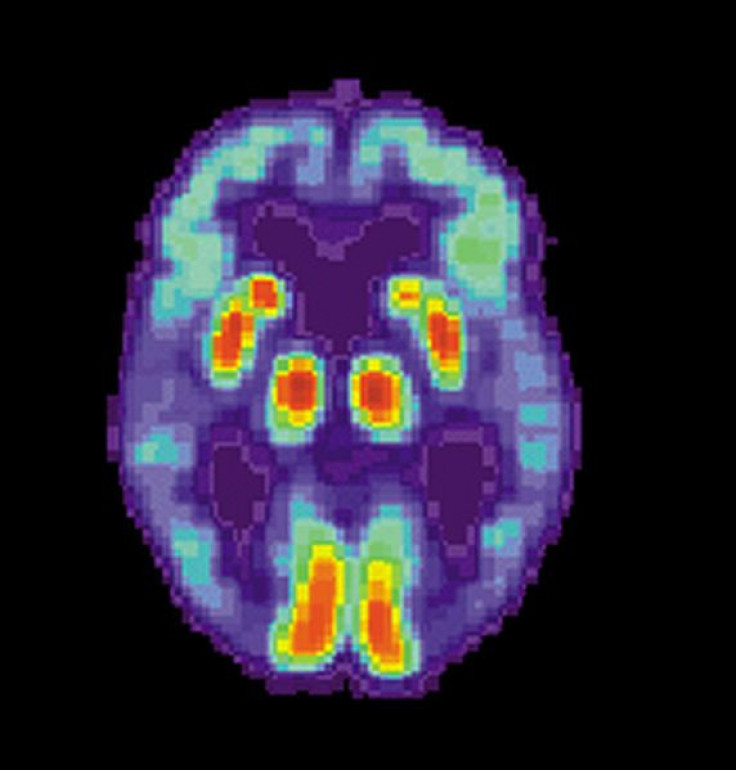 PET scan Alzheimer