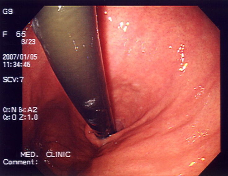 stomach endoscopy
