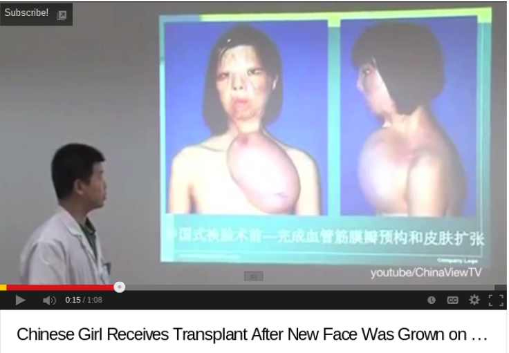 Chinese Teenager Grows New Face On Chest