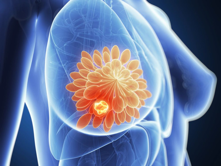 breast-cancer-3d-rendering