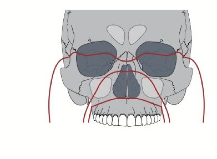 shutterstock image of face fractures