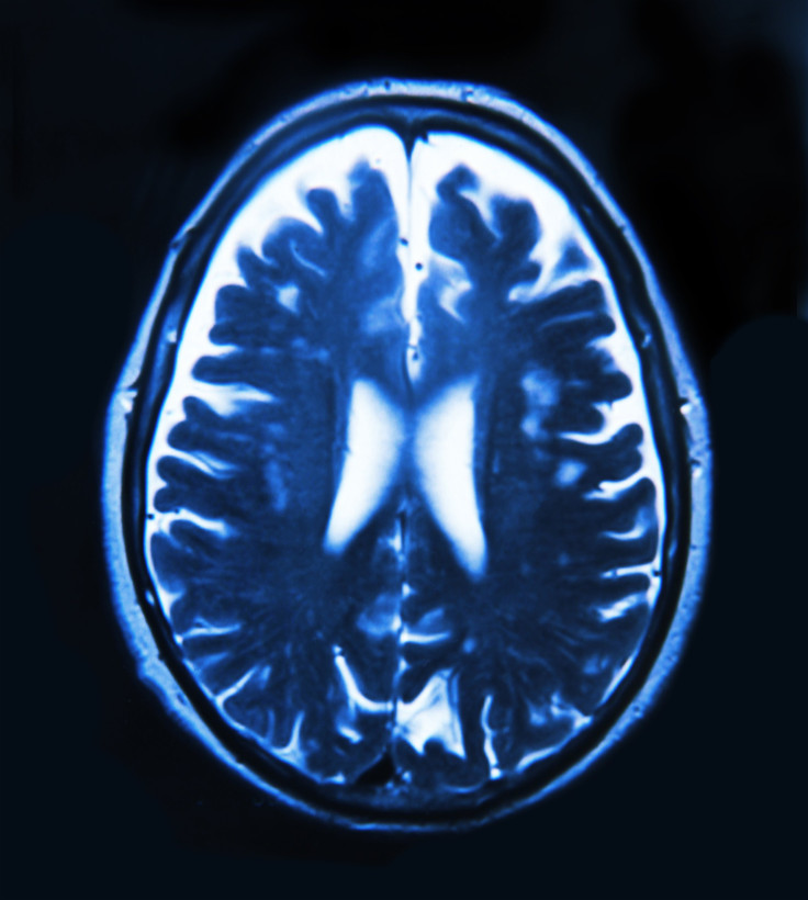 shutterstock photo of brain scan