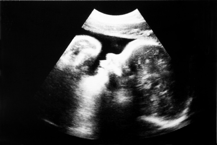 fetus ultrasound