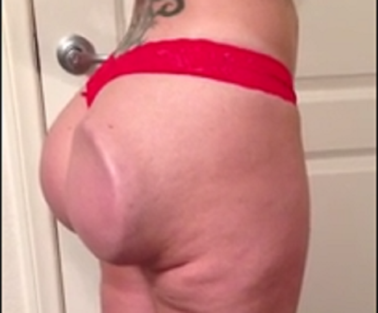 butt implant