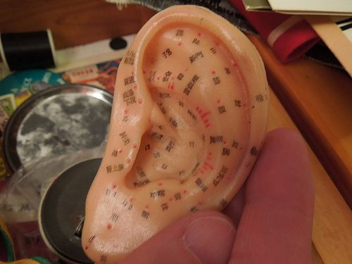 acupuncture