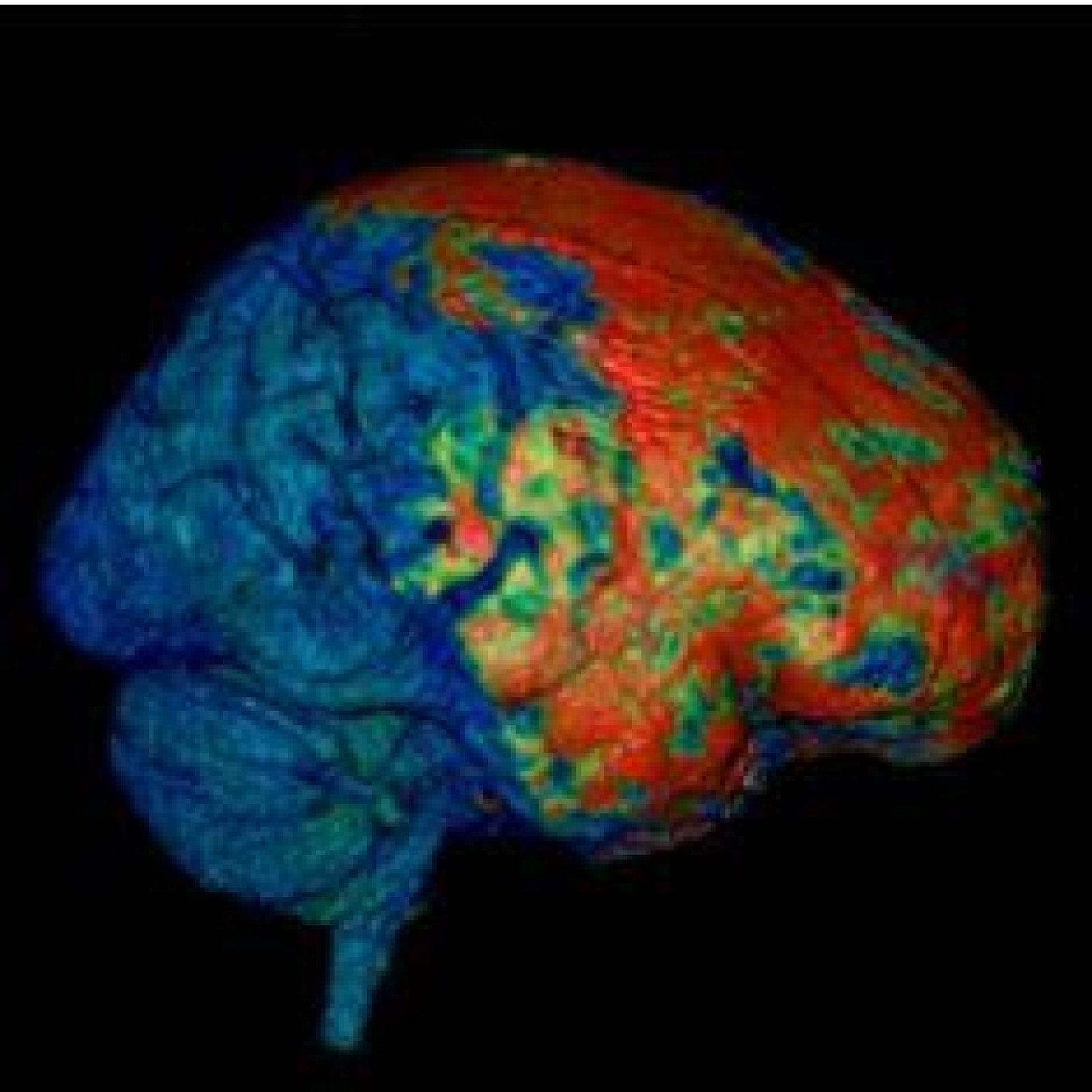 glutathione concussion 61 (10B) Neurometabolite measurement through magnetic resonance spectroscopy is associated with physical activity after pediatric Glutathione IV Therapy For Fighting
