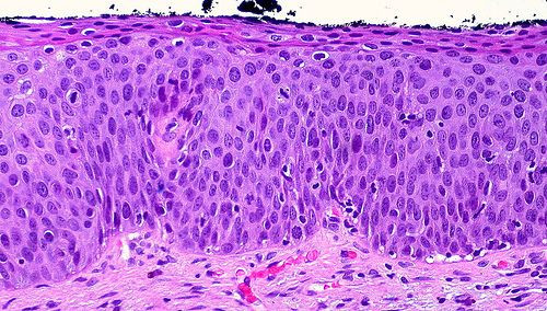 hpv1
