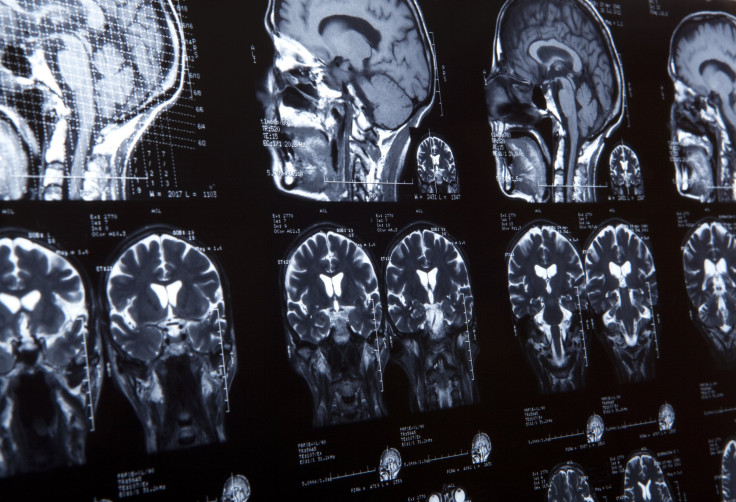 shutterstock photo of brain scans