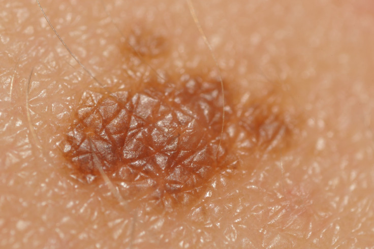 Drug Duo Approved For Advanced Melanoma Therapy