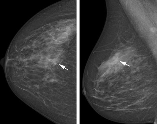 Which Mammogram Screening System Is Best? New Photon-Counting Technique ...