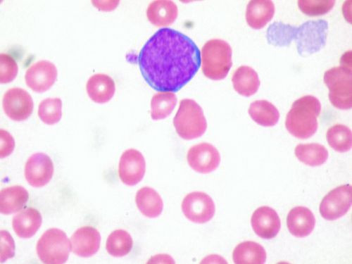 leukemia