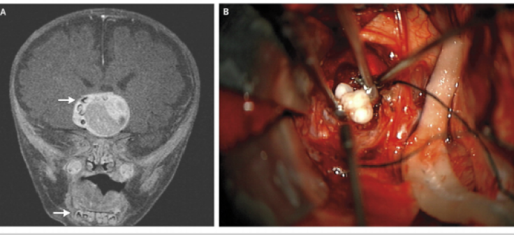 Tooth in Brain