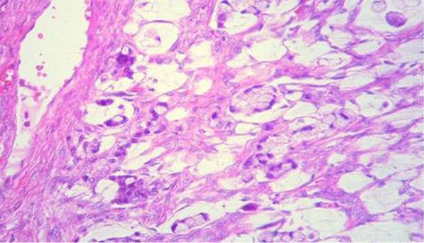 tumor1