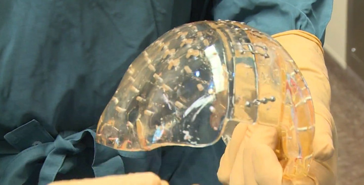 Surgeons Replace Skull With 3D-Printed Plastic Cap