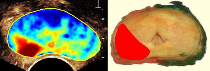 prostate1