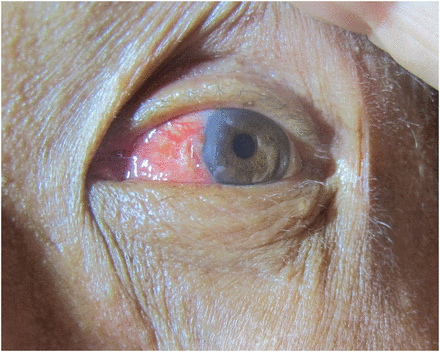 Surfer treats eye condition with 30-foot wave to remove fibrous tissue