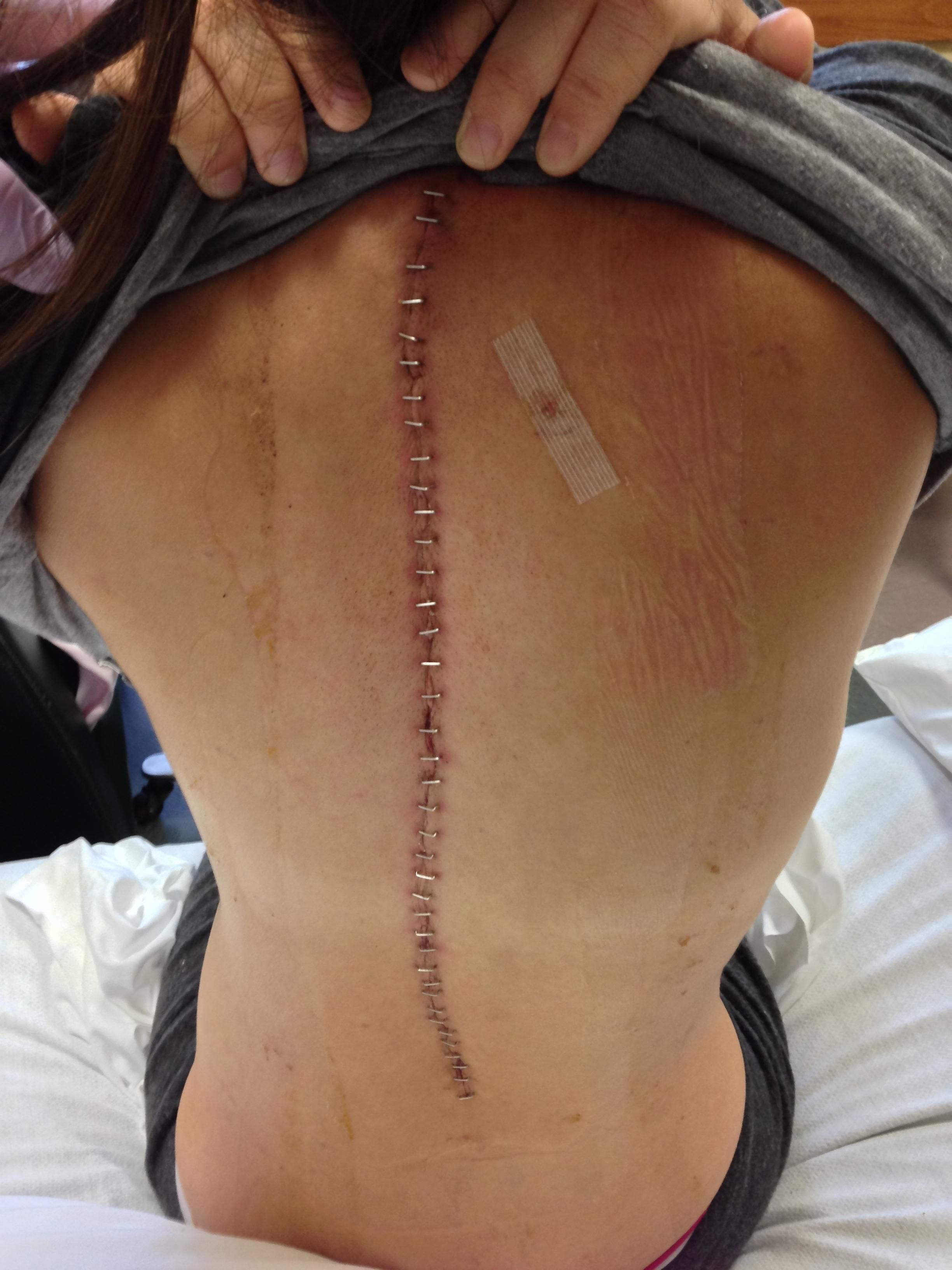 Minimally invasive lumbar spinal fusion incorporating tattoo lines in the  incisions Case report  ScienceDirect