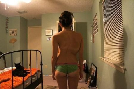 One patient bravely revealed photos of both her pre-op and post-op body to show the results of scoliosis surgery, a type of spinal fusion.