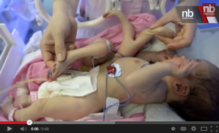 Baby born with extra limbs