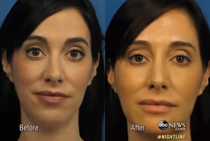Woman spends $15K on plastic surgery for perfect selfie