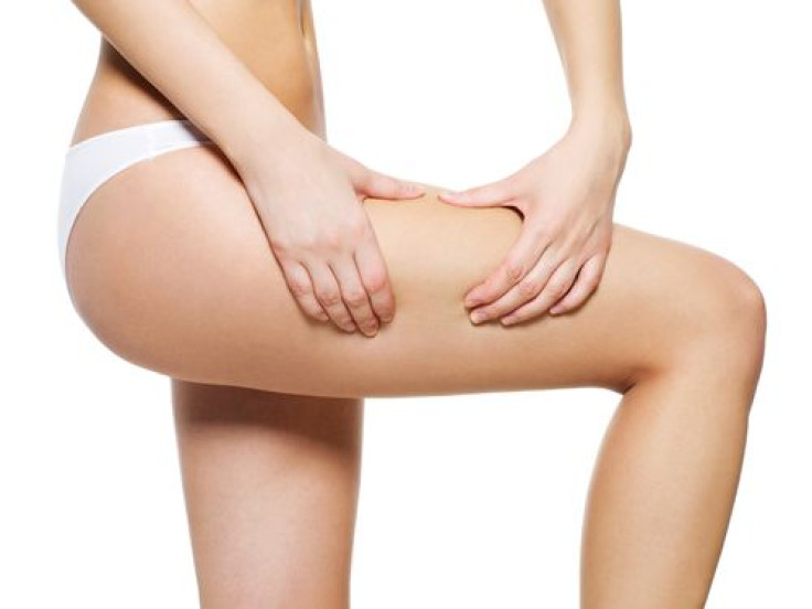 Woman applying cosmetic cream from cellulite on leg