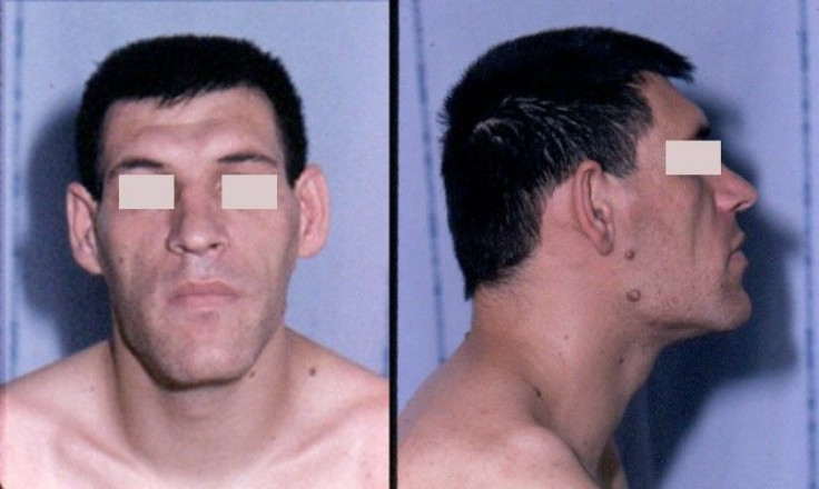 Acromegaly_facial_features