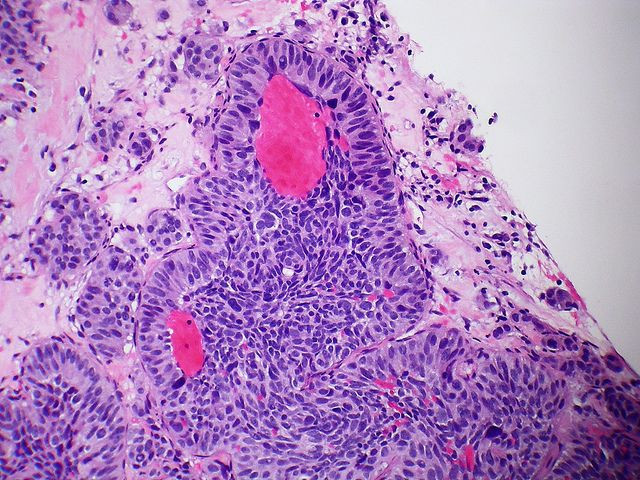 metastasis
